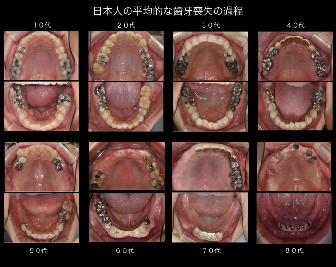 日本人の平均的な歯牙喪失の過程
